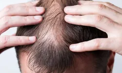 Eliminate scalp fungus in one go!
