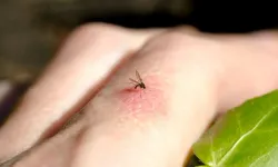 Five Natural Remedies for Mosquito Bites