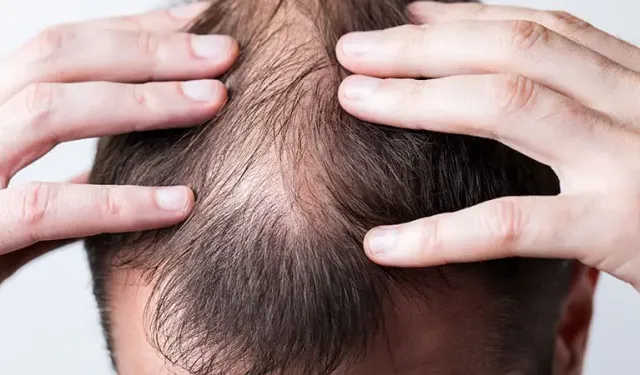 Eliminate scalp fungus in one go!