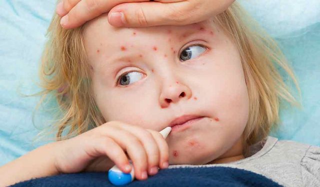Measles alert in the UK!