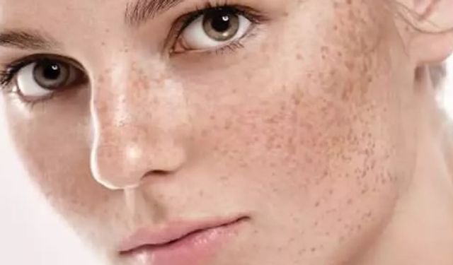 How to get rid of sun spots? What are the natural ways to get rid of sun spots?