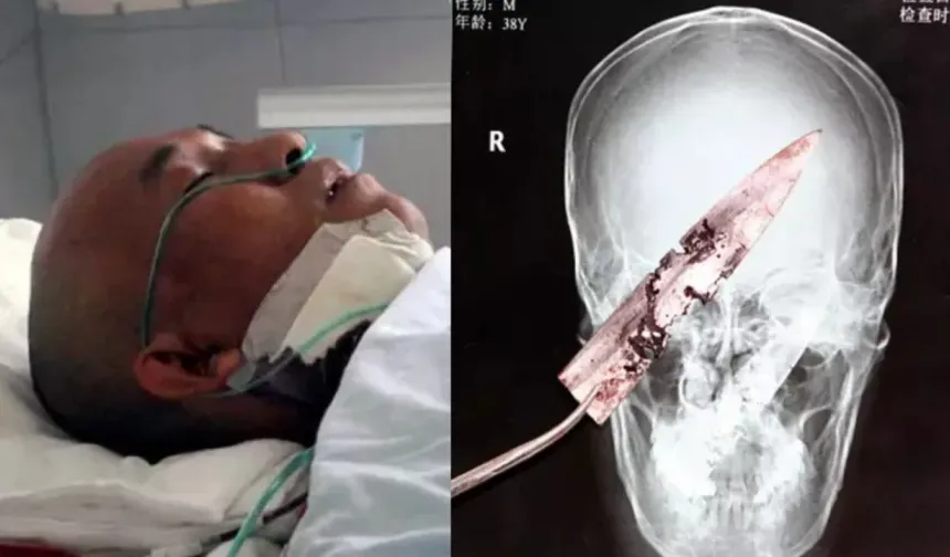 Man with headache learns he had a rusty knife in his head for 4 years