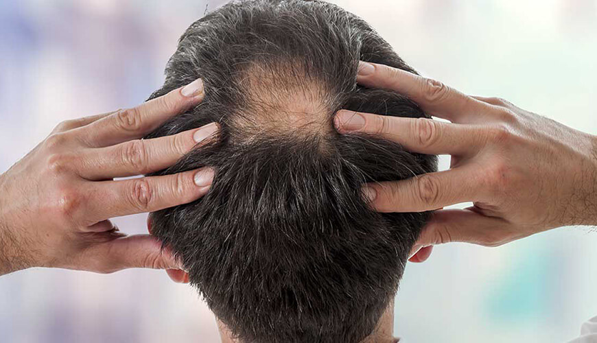 There will be no trace of dandruff and eczema on the scalp with this method. You will see that the scalp is in a healthy condition in a short time. Here is that effective formula that restores your scalp to health